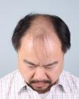 Before Hair Transplant&nbsp;Front
